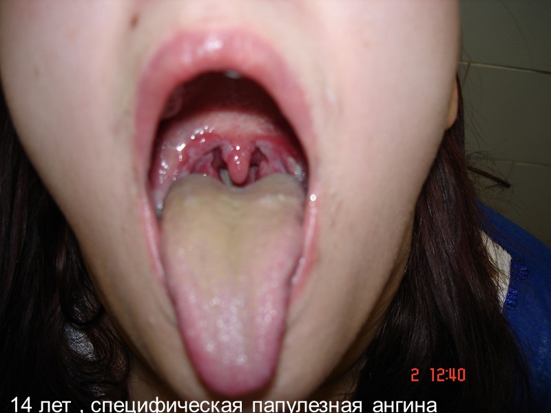 14 лет , специфическая папулезная ангина